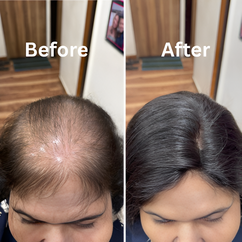 Hair topper covering a thinning crown with a natural parting