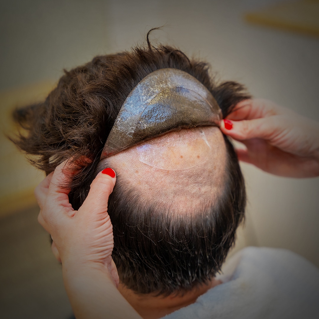 Before and after of a men's non-surgical hair patch
